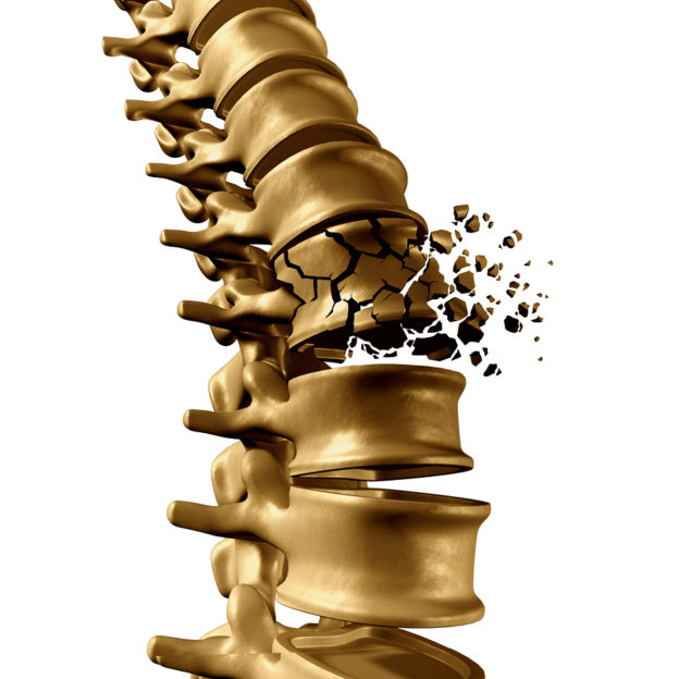Spinal Fracture and traumatic vertebral injury medical concept as a human anatomy spinal column with a broken burst vertebra due to compression or other osteoporosis back disease on a white background