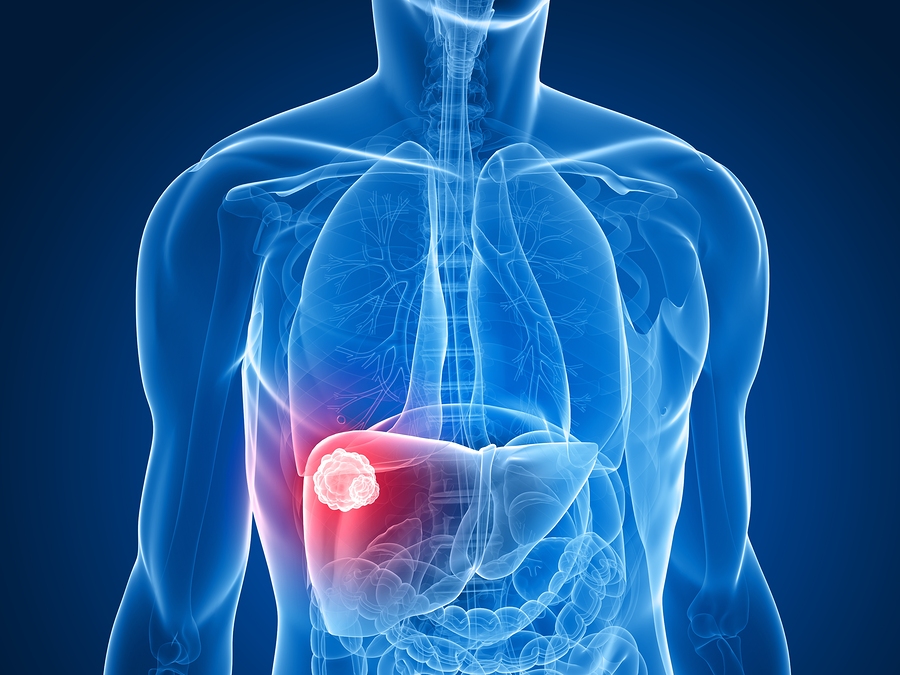 nafld-the-surge-in-liver-cancer-advanced-natural-wellness