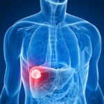 Why is Liver Cancer on the Rise?