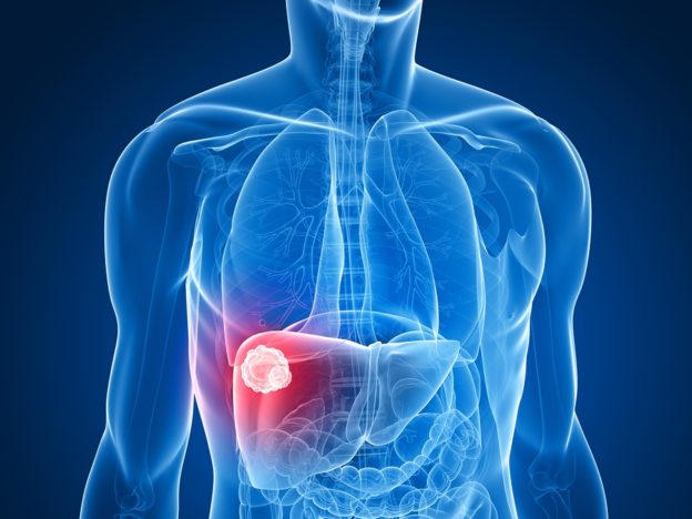 fatty liver and liver cancer, does NAFLD cause cancer, how to reverse fatty liver, best diet for fatty liver, can exercise reverse fatty liver, best supplements for NAFLD, best supplements for fatty liver, what liver supplements should I take