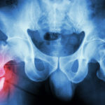 5 Nutrients to Prevent Hip Fractures