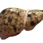 What’s Ruining Your Liver?